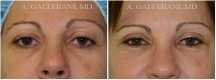 Blepharoplasty - Patient D