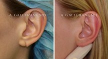 Otoplasty - Patient D
