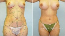 Liposuction - Patient D