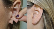 Otoplasty - Patient D