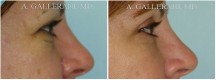 Blepharoplasty - Patient D