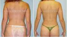 Liposuction - Patient D