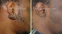 Otoplasty - Patient E