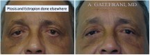 Blepharoplasty - Patient E