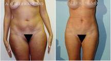 Liposuction - Patient E