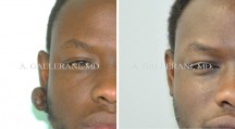 Otoplasty - Patient E