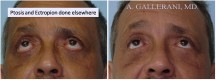 Blepharoplasty - Patient E
