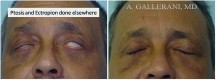 Blepharoplasty - Patient E