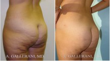 Liposuction - Patient E