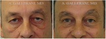 Blepharoplasty - Patient I