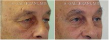 Blepharoplasty - Patient I