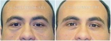 Blepharoplasty - Patient K