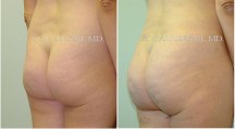 Liposuction - Patient G