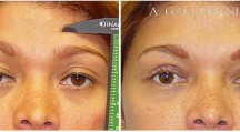 Blepharoplasty - Patient C