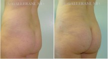 Liposuction - Patient G