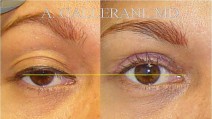 Blepharoplasty - Patient C