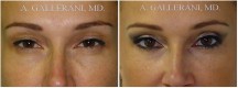 Blepharoplasty - Patient L