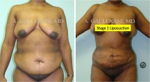 Liposuction - Patient H