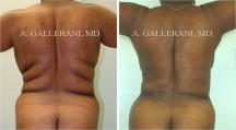Liposuction - Patient H
