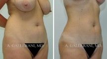 Liposuction - Patient I