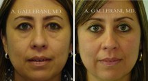 Blepharoplasty - Patient G