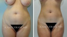 Liposuction - Patient I