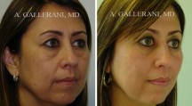 Blepharoplasty - Patient G