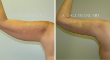 Liposuction - Patient J