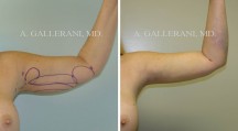 Liposuction - Patient J