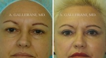 Blepharoplasty - Patient H