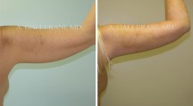 Liposuction - Patient J