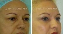 Blepharoplasty - Patient H