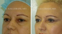 Blepharoplasty - Patient H