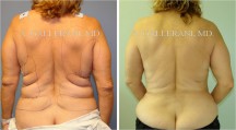 Liposuction - Patient K